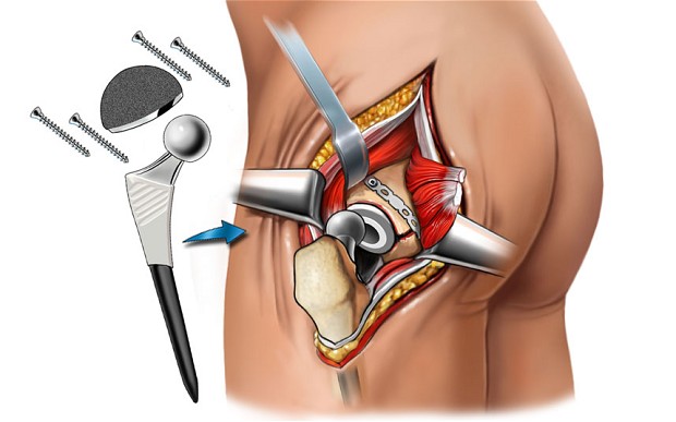 Total hip replacement surgery
