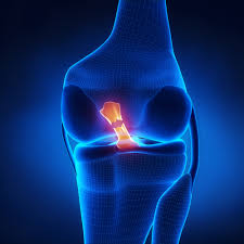 Physical therapy post Anterior Cruciate Ligament (ACL) surgery