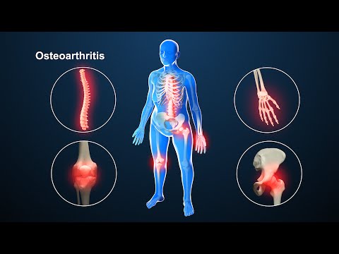osteoarthritis gyógymódjai fájdalom a bal lapocka közelében, közelebb a gerinchez