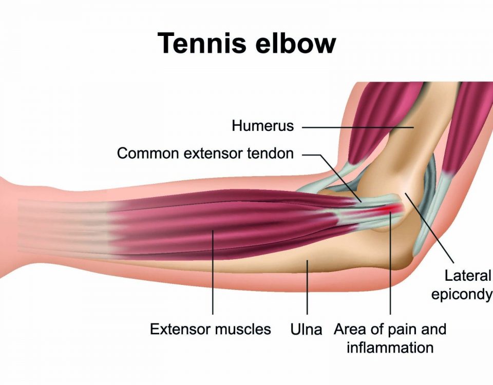 Acute Tennis Elbow