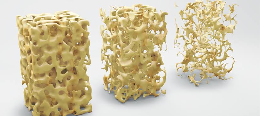 Osteoporosis condition