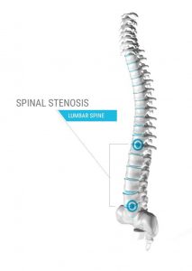 Prevent Spinal Stenosis from getting worse