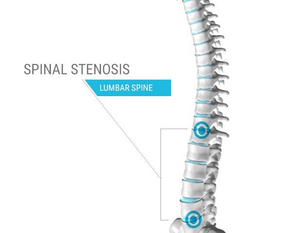 Prevent Spinal Stenosis from getting worse