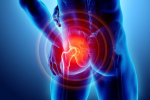 Early symptoms of hip arthritis