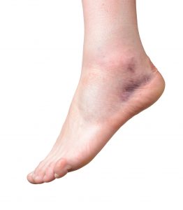 RECOVER FROM ANKLE SPRAIN