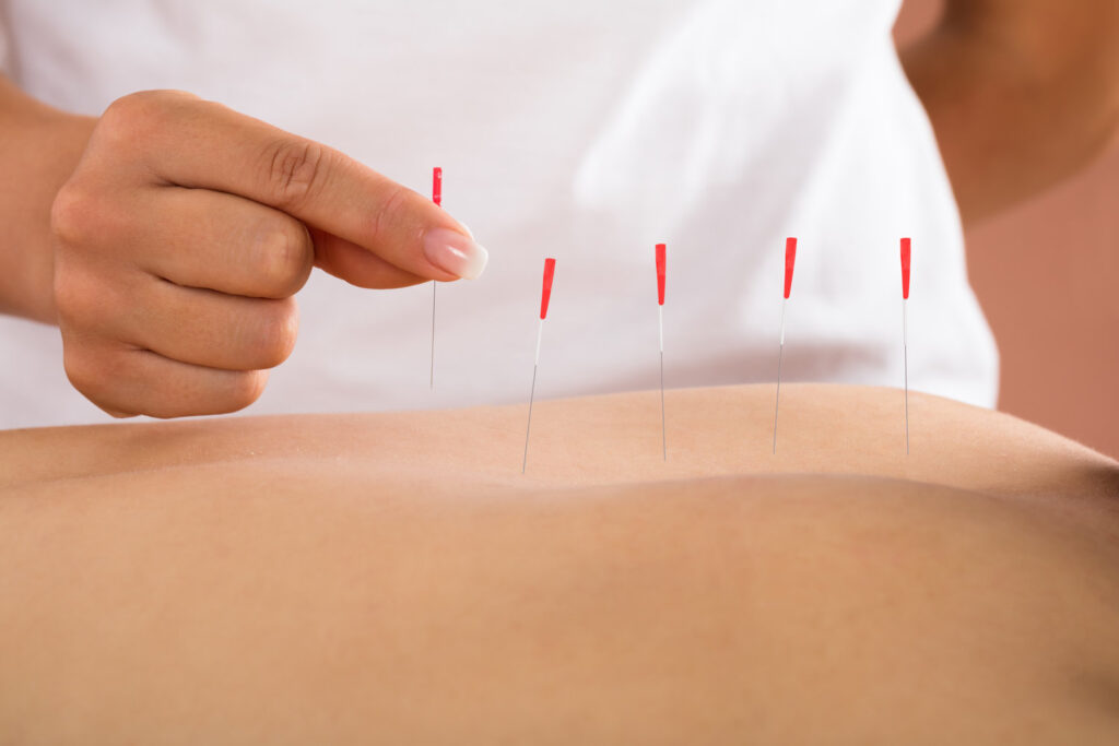 Dry Needling: A Deeper Dive into Muscular Relief