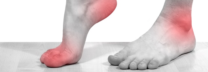 Plantar fasciitis