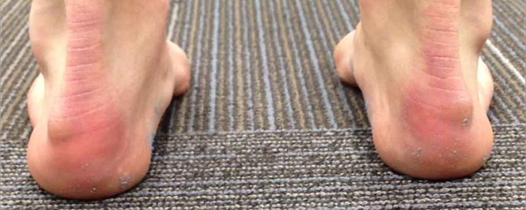 achilles-tendinitis-2