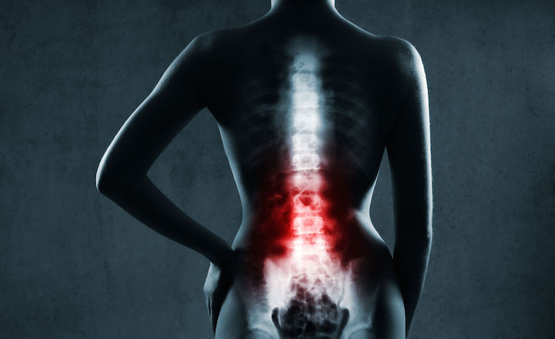 Ankylosing spondylitis