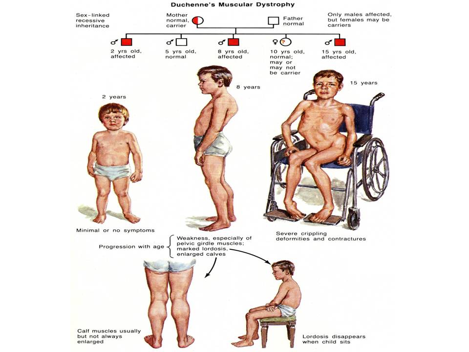 Muscular Dystrophy