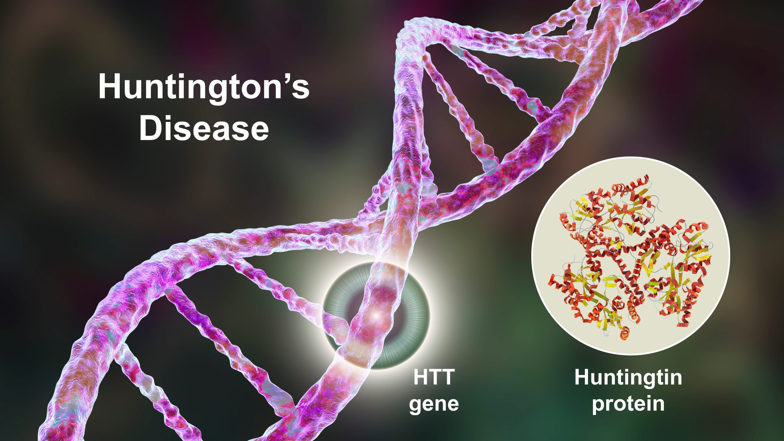 Huntington’s Disease